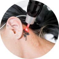un tratamiento láser de eliminación de tatuajes